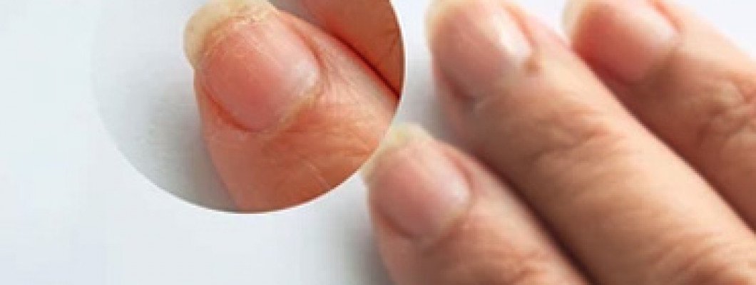 Solutions pour lutter contre les Problèmes des Ongles Fragiles, Dédoublés et Secs