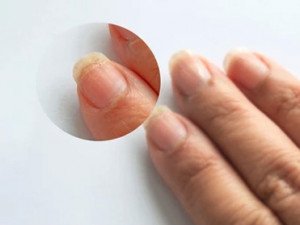 Solutions pour lutter contre les Problèmes des Ongles Fragiles, Dédoublés et Secs Solutions pour lutter contre les Problèmes des Ongles Fragiles, Dédoublés et Secs