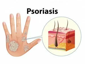 Le Psoriasis : Plus qu'une Affection Cutanée, une Lutte au Quotidien