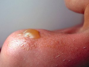Coup de soleil : comprendre les causes et savoir comment le traiter Coup de soleil : comprendre les causes et savoir comment le traiter