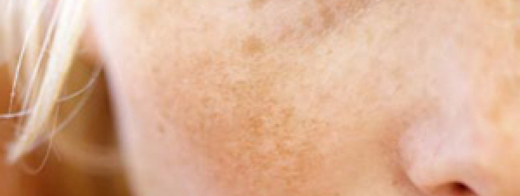 Taches brunes : conséquences sur la peau et traitement